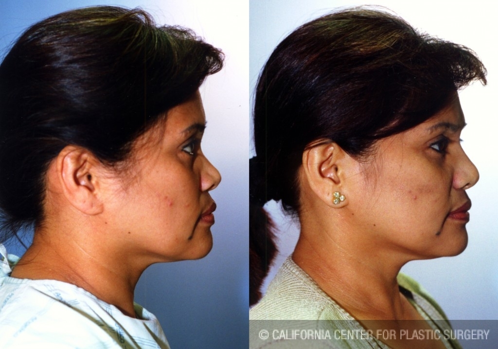 best rhinoplasty surgeons