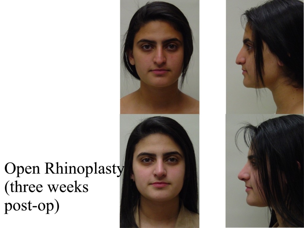 best rhinoplasty surgeons